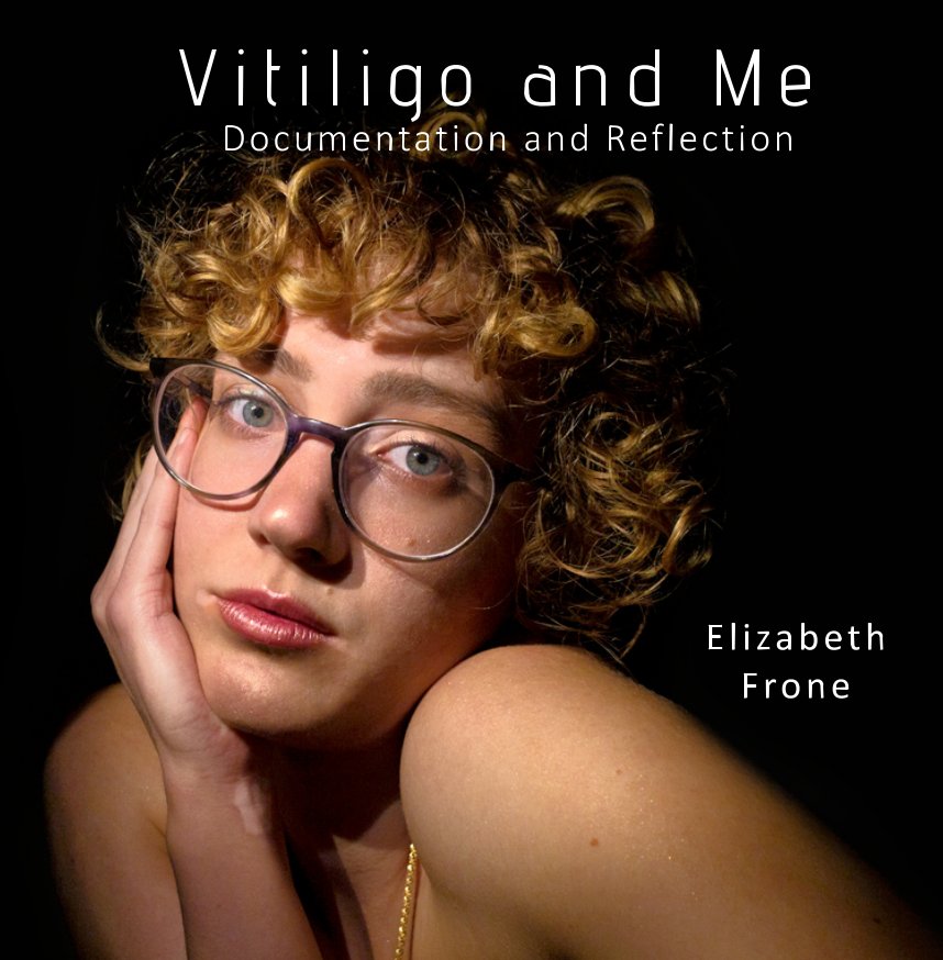 View Vitiligo and Me by Elizabeth Frone