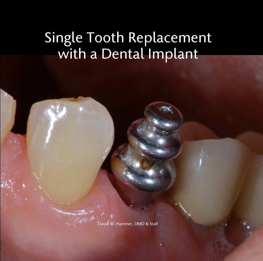Ver Single Tooth Replacement with a Dental Implant por David W. Hammer, DMD & Staff