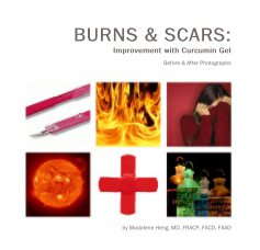 BURNS & SCARS: Improvement with Curcumin Gel book cover