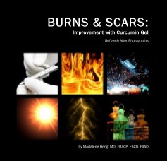 BURNS & SCARS: Improvement with Curcumin Gel book cover