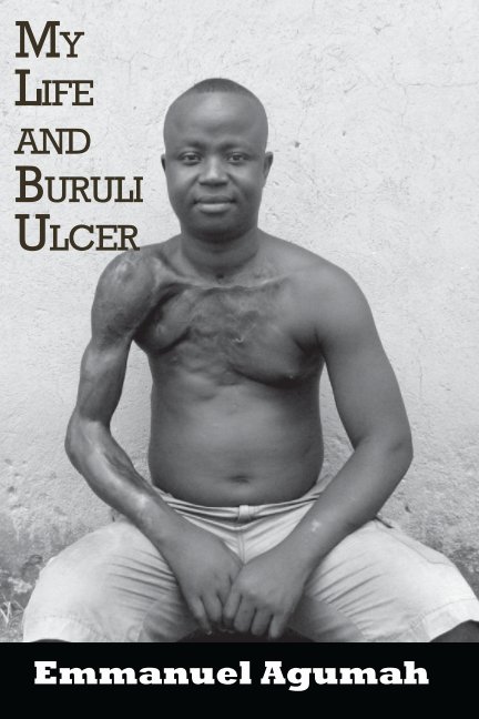 View My Life and Buruli Ulcer by Emmanuel Agumah